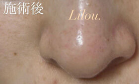 アフターの写真