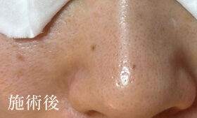 アフターの写真
